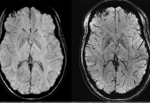 Redefining Brain Tumor Care