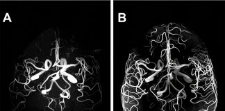 Raising the Bar for Brain Tumor Care